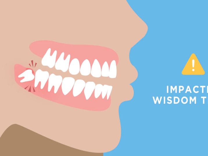 HERO images How Long Does it Take to Heal Following Wisdom Teeth Removal 1200x630
