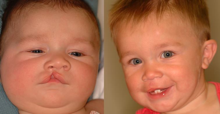 Toddler before and after cleft lip/palate surgery