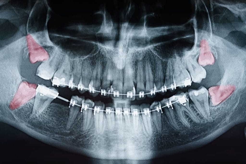 Before Wisdom Teeth Removal Why To Monitor Wisdom Teeth Coming In