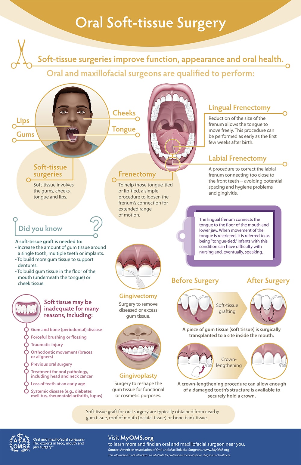 Oral Soft-tissue Surgery Infographic