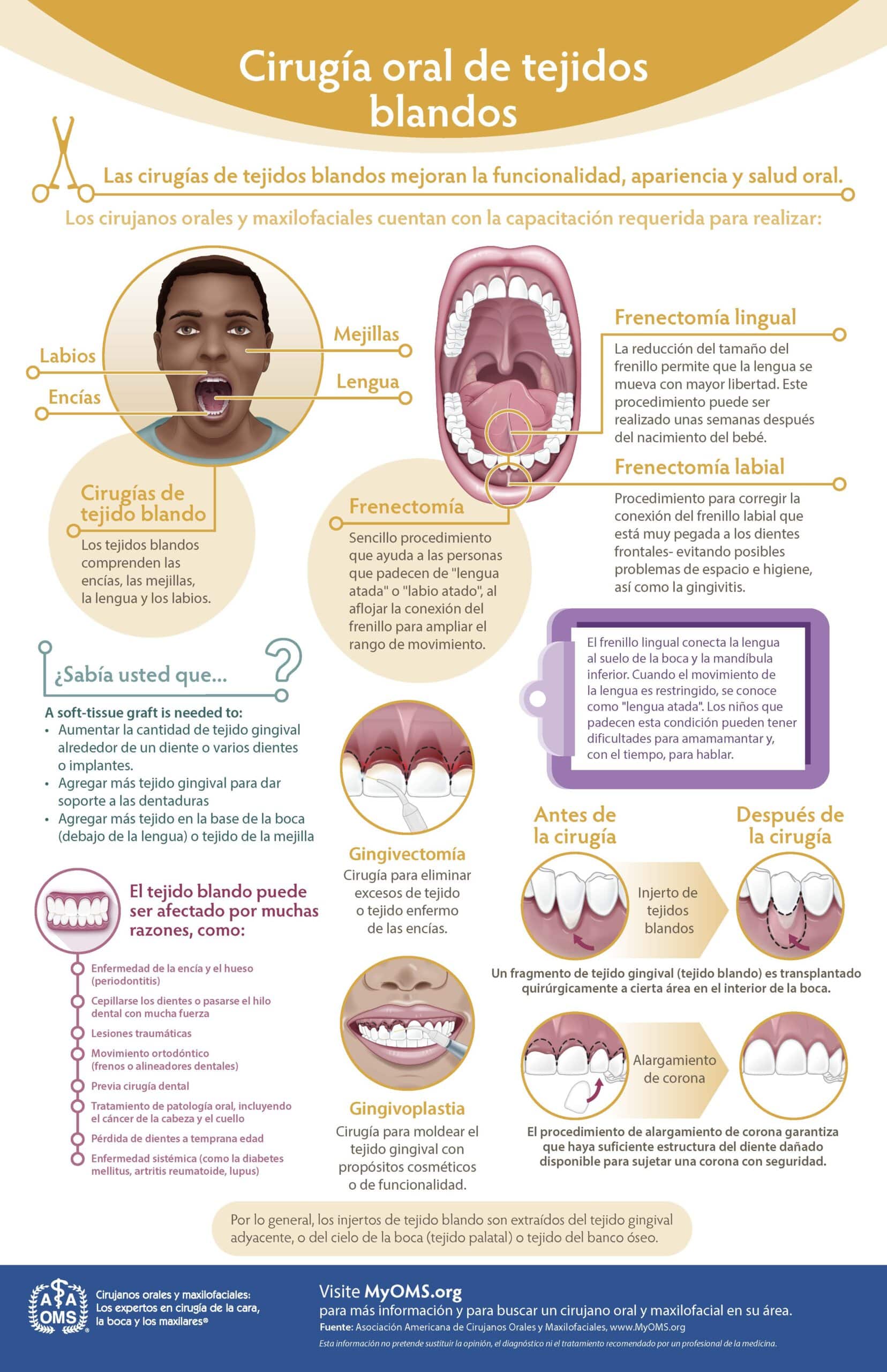 Oral Soft Tissue Surgery Infographic (Spanish)