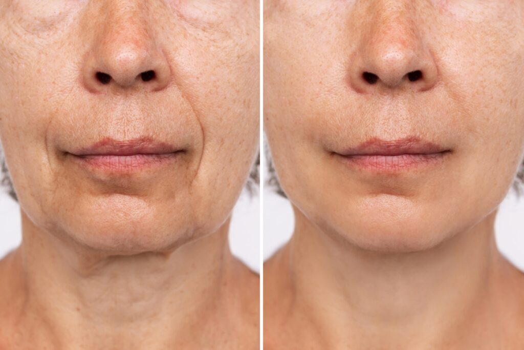 Lower part of face and neck of elderly woman with signs of skin aging before after plastic surgery