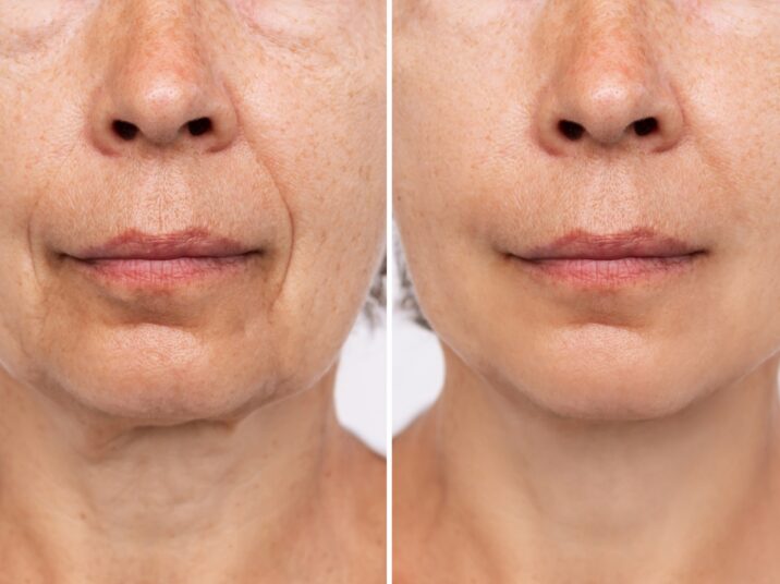 Lower part of face and neck of elderly woman with signs of skin aging before after plastic surgery