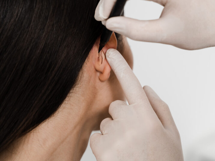 Surgeon draw marking on ear before otoplasty cosmetic surgery. Otoplasty markup before ear surgery. Otoplasty mark-up for surgical reshaping of pinna and ear.