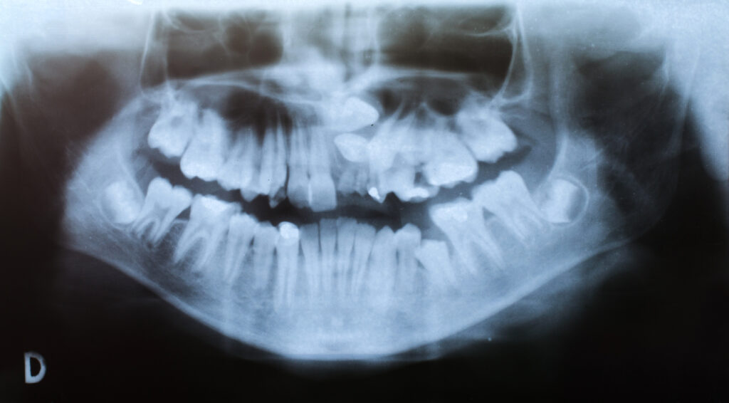 Dental X-Ray - serious deformation
