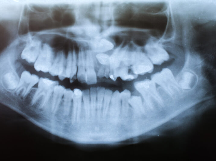 Dental X-Ray - serious deformation