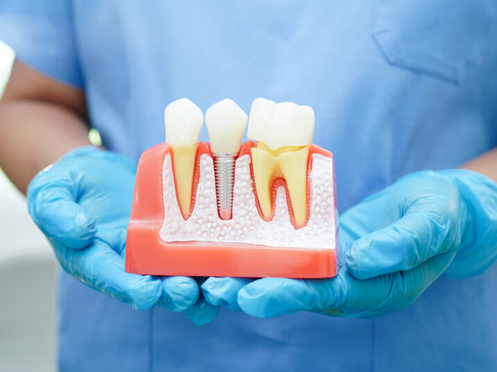 Doctor hold dental implant, artificial tooth roots into jaw, root canal of dental treatment, gum disease, teeth model for dentist studying about dentistry.
