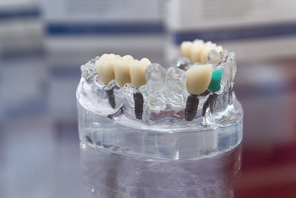 Ceramic dental veneers installation