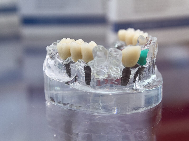 Ceramic dental veneers installation