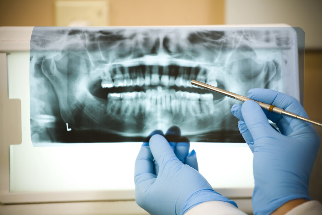 Dental X-Ray