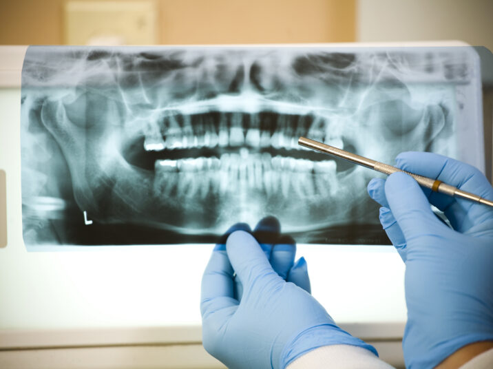 Dental X-Ray