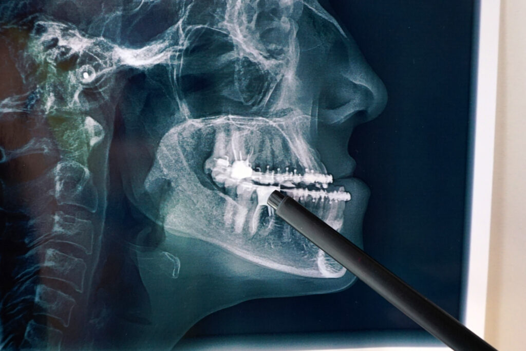Ct,Scan,Of,Teeth,With,Braces,In,Consultation,With,A