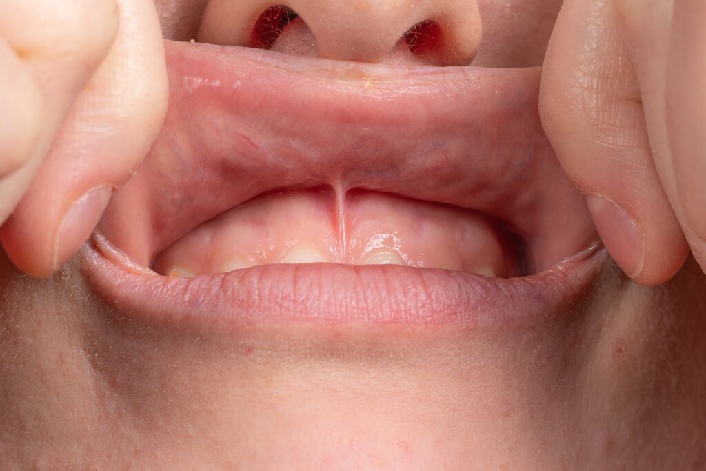 Medical,Inspection,Of,The,Superior,Labial,Frenulum,To,Evaluate,The