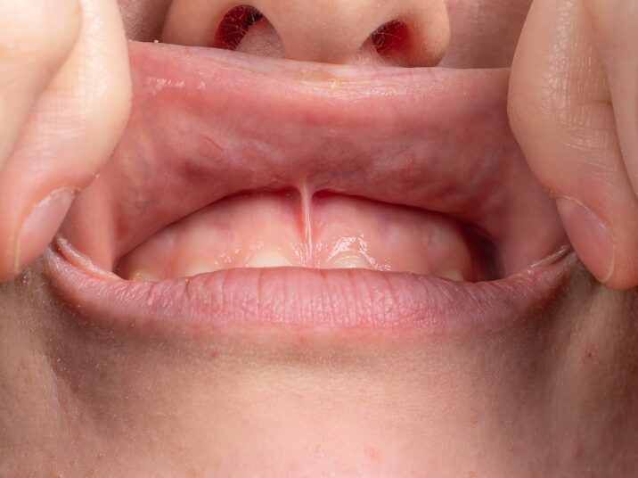 Medical,Inspection,Of,The,Superior,Labial,Frenulum,To,Evaluate,The