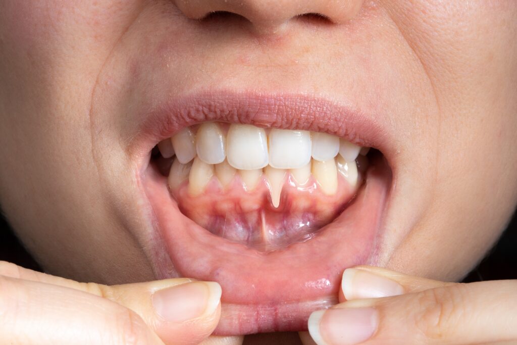 Macro,Of,A,Female,Mouth,With,Receding,Gums.,Close-up,Of