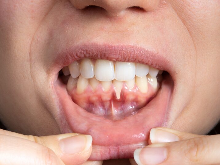 Macro,Of,A,Female,Mouth,With,Receding,Gums.,Close-up,Of
