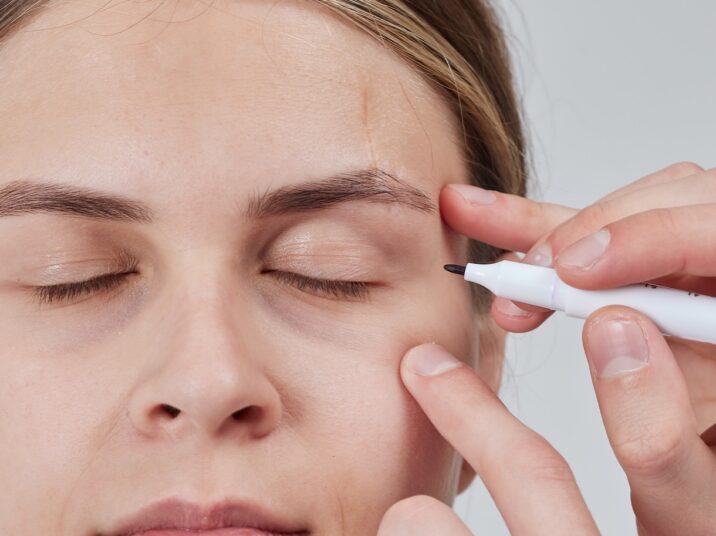 Blepharoplasty of a woman marking on her face before plastic surgery to change the eye area in a medical clinic