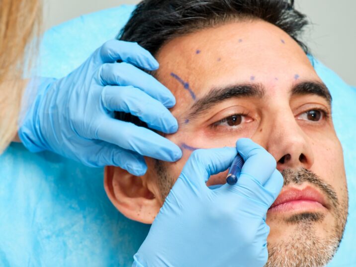 Aesthetic medicine doctor marking the face of a 45-year-old male patient to perform an anti-aging