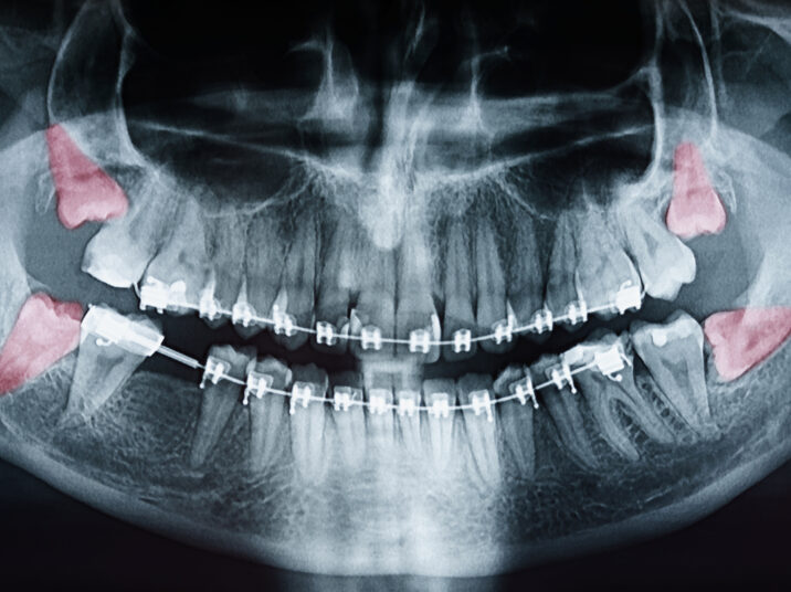 Growing Wisdom Teeth Pain On X-Ray