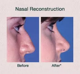 Nasal reconstruction