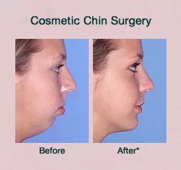 cosmetic chin surgery