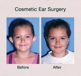 cosmetic ear surgery