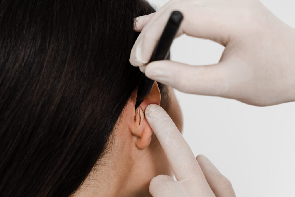 Surgeon draw marking on ear before otoplasty cosmetic surgery. Otoplasty markup before ear surgery. Otoplasty mark-up for surgical reshaping of pinna and ear.