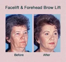 face lift and brow lift