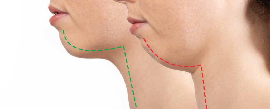 Chin Surgery