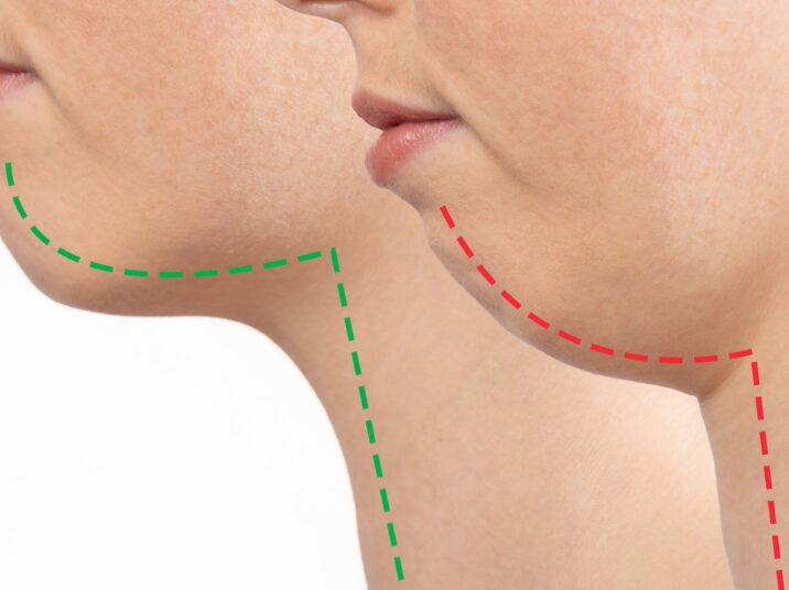 Chin Surgery