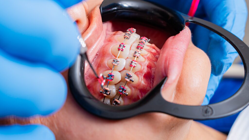 Close-up of dental braces