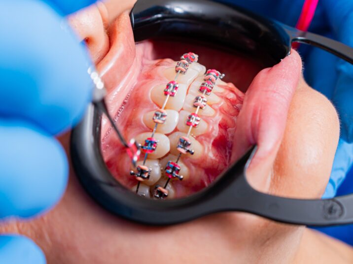 Close-up of dental braces