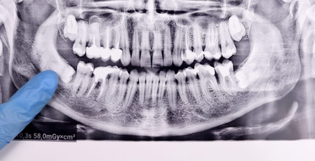 Dentist,Points,Finger,At,Wisdom,Tooth,At,Panoramic,Dental,Tooth