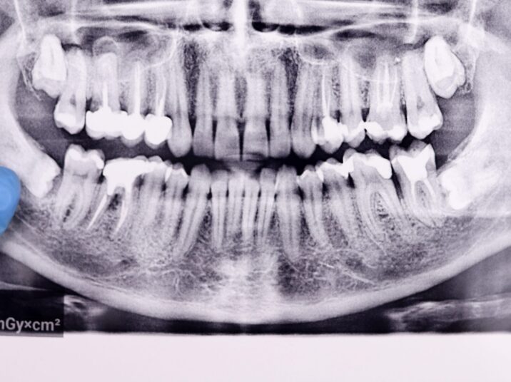 Dentist,Points,Finger,At,Wisdom,Tooth,At,Panoramic,Dental,Tooth