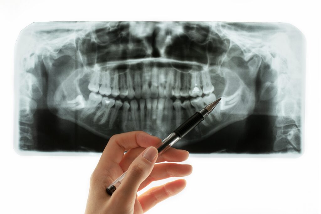 Wisdom Teeth FAQ