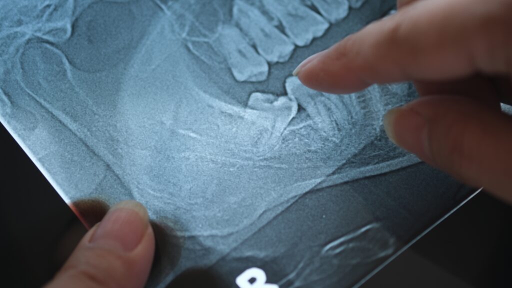 Panoramic,X-ray,Image,Of,Teeth,And,Mouth,With,Wisdom,Teeth