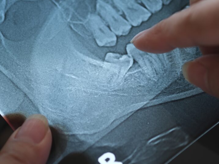 Panoramic,X-ray,Image,Of,Teeth,And,Mouth,With,Wisdom,Teeth