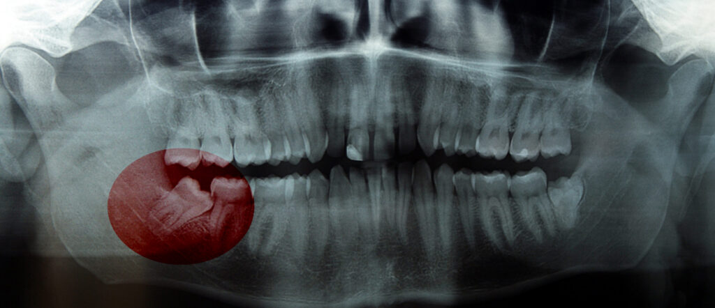 Rtg,,X-ray,,Radiology,Photo,Of,Wisdom,(eight),Tooth.