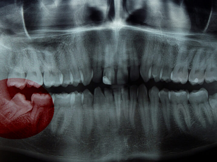 Rtg,,X-ray,,Radiology,Photo,Of,Wisdom,(eight),Tooth.