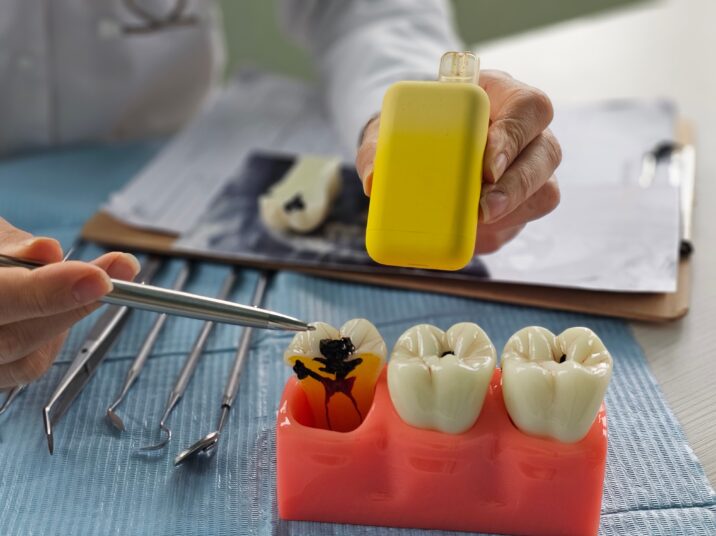 Jaw,Model,With,Electronic,Vaping,Device.,Vaping,Causes,Tooth,Decay.