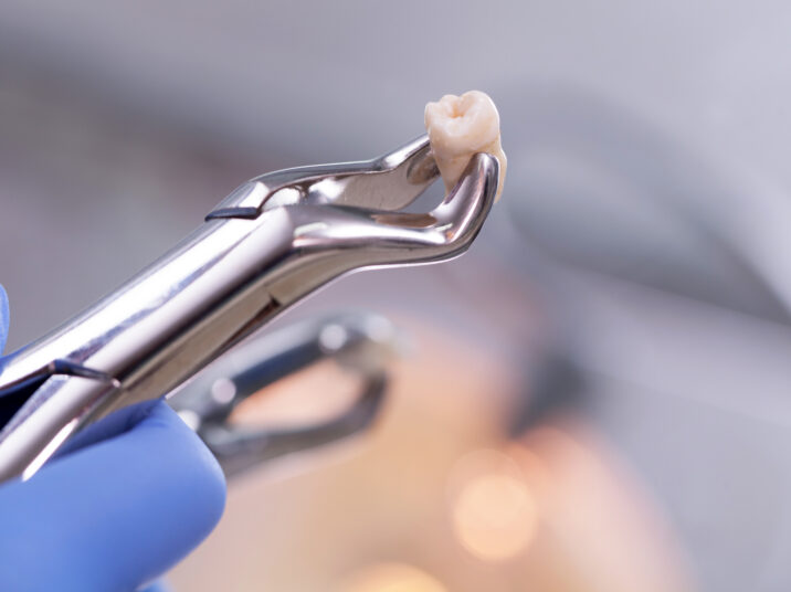 Dental,Equipment,Holding,An,Extracted,Tooth