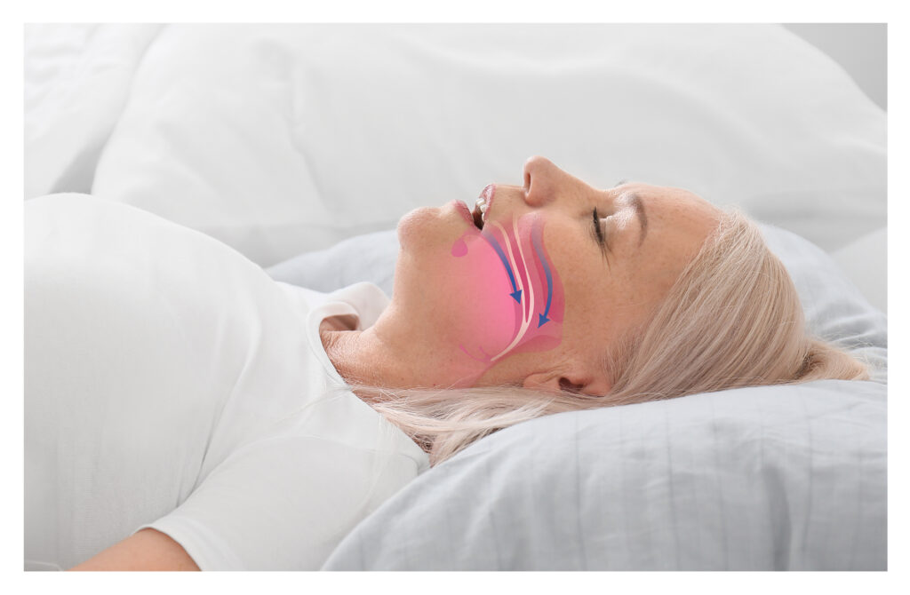 Obstructive Sleep Apnea (OSA)